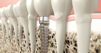 Síntomas del rechazo de un implante dental